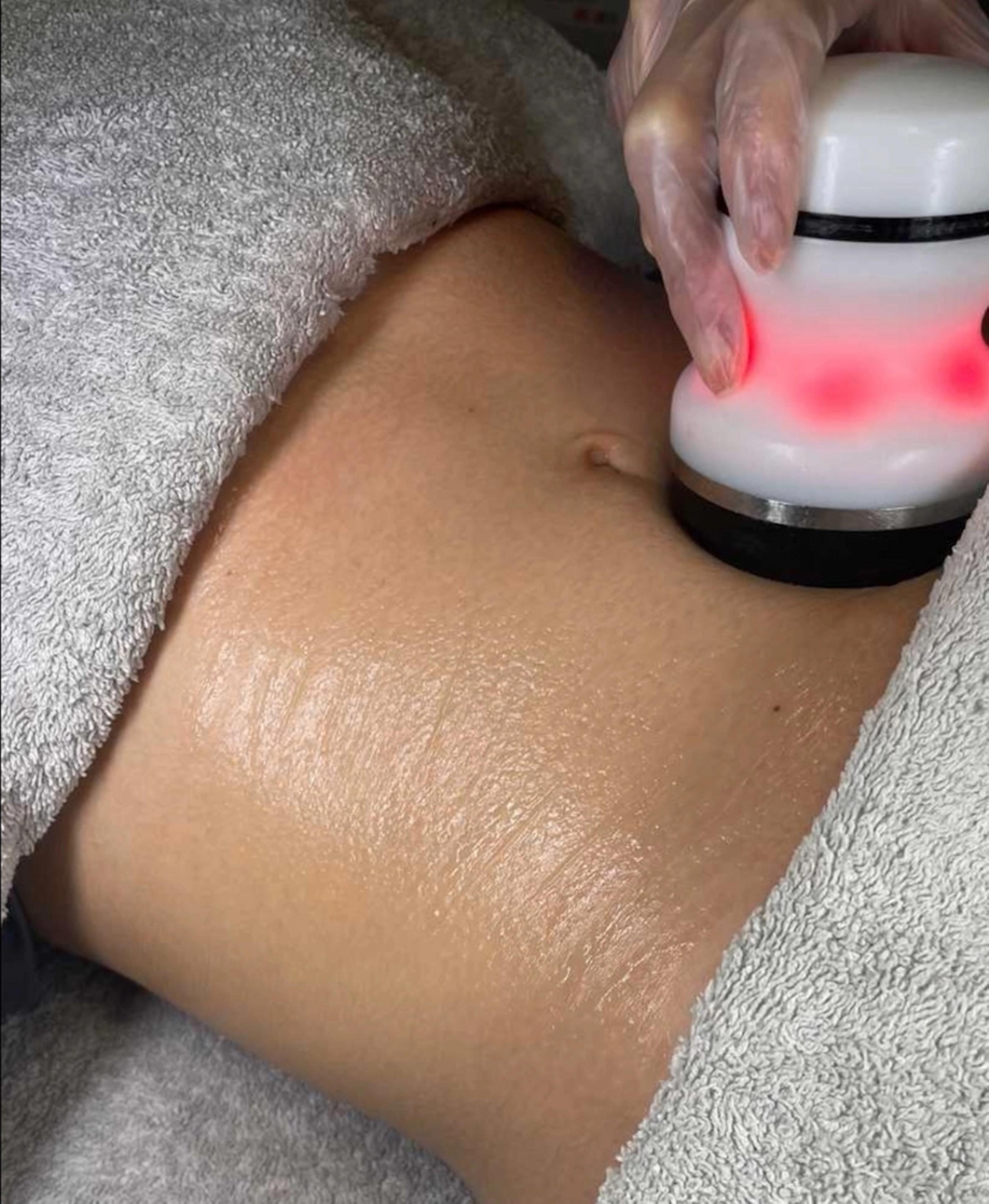 Body sculpting: Radiofrequency | Fat cavitation | Electroestimulation